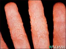 A.D.A.M. > Dermatitis