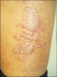 Stasis dermatitis.