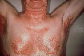 seborrheic dermatitis