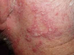 Dermatitis 6 Dermatitis 6