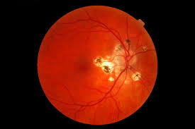 Presumed ocular histoplasmosis