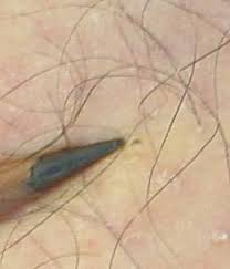 Deer Tick Larva in my leg