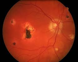 CNV Ocular histoplasmosis